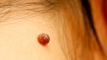 58144787 - birthmark on skin. mole closeup